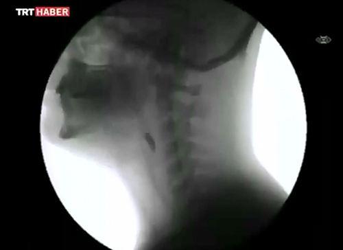 X-Ray`de insann yemek yeme an  nsann yemek yerken vcudunda neler olduu X-Ray cihaznda byle gsteriliyor.